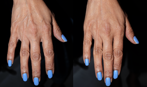 Cheek Filler dermal filler Before After Mississauga Oakville